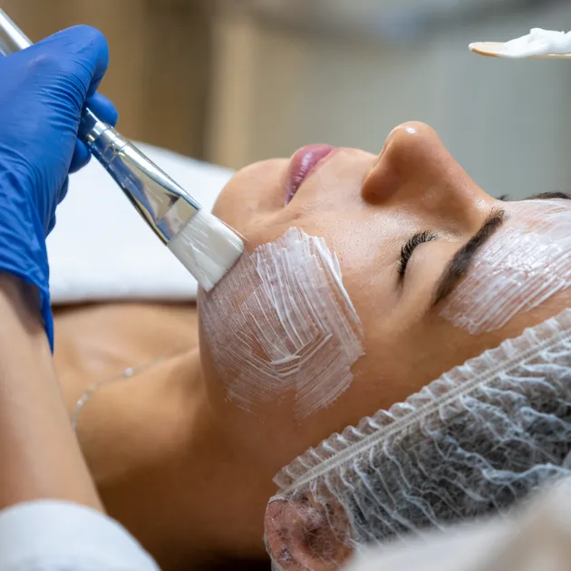 Peeling Químico